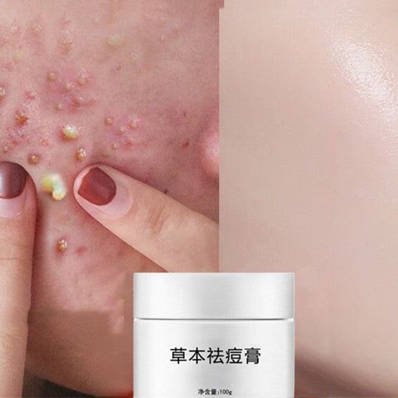 Herbal Lightening Acne Cream